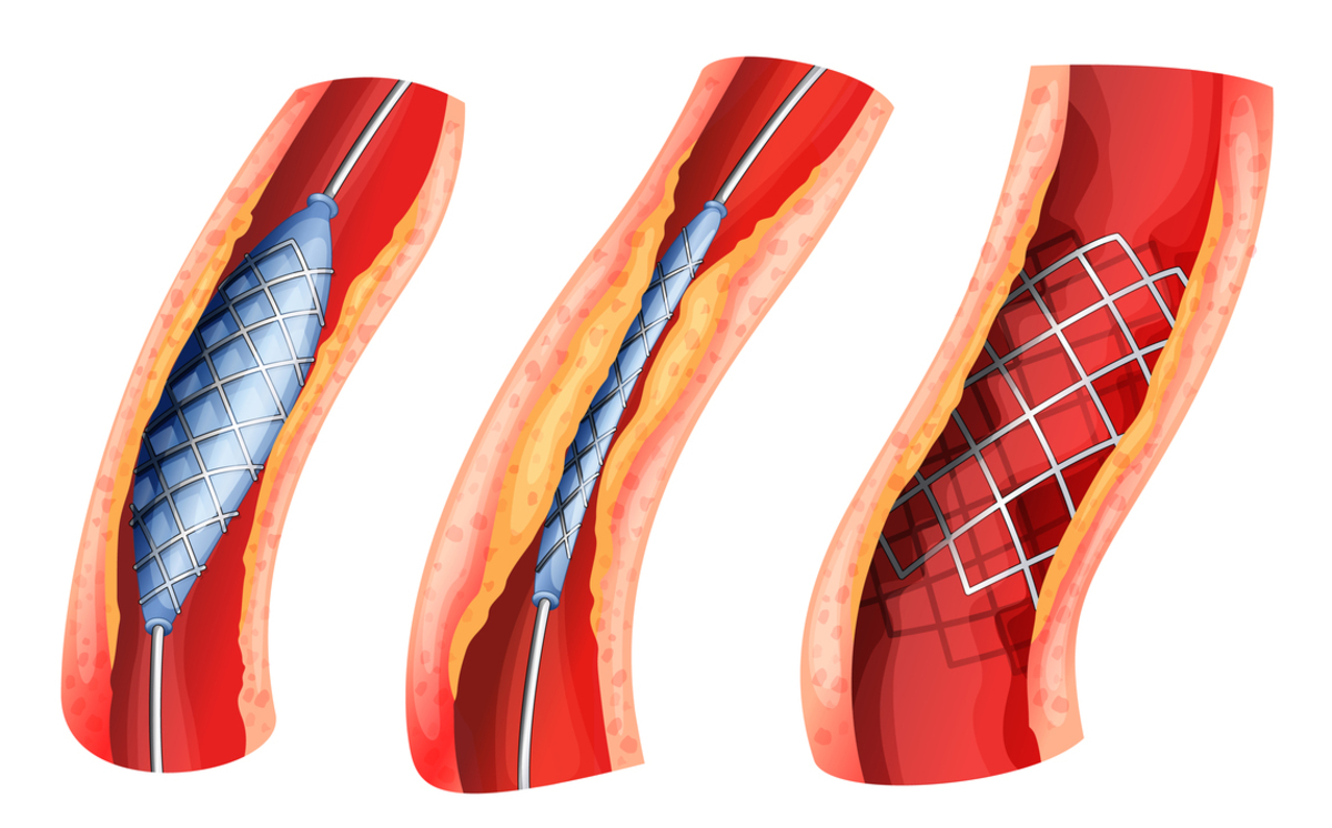 3-common-types-of-heart-attack-treatments-cardiovascular-disorders