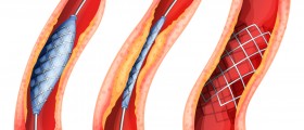 3 Common Types Of Heart Attack Treatments