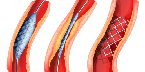 3 Common Types Of Heart Attack Treatments