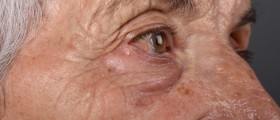 Can Coral Calcium Treat And Prevent Alzheimer's Disease?