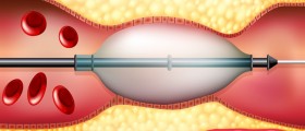 Coronary Artery Disease Treatment. 6 Things You Should Know About Coronary Angioplasty with Stents