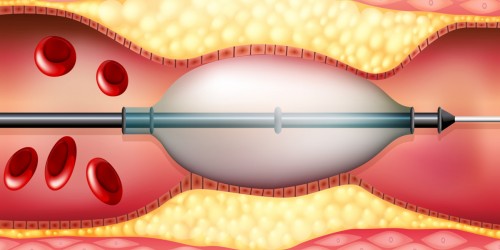 Coronary Artery Disease Treatment. 6 Things You Should Know About Coronary Angioplasty with Stents