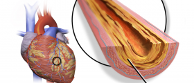 Do Bad Habits Drive Up Your Triglycerides?