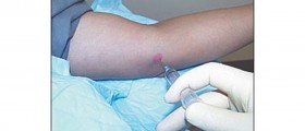 Most common uses of Corticosteroids
