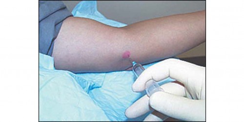 Most common uses of Corticosteroids