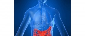 Crohn's disease- chronic inflammation of the digestive tract