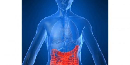 Crohn's disease- chronic inflammation of the digestive tract