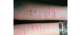 Self-Injury Disorder