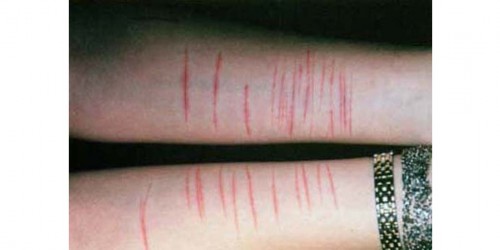 Self-Injury Disorder
