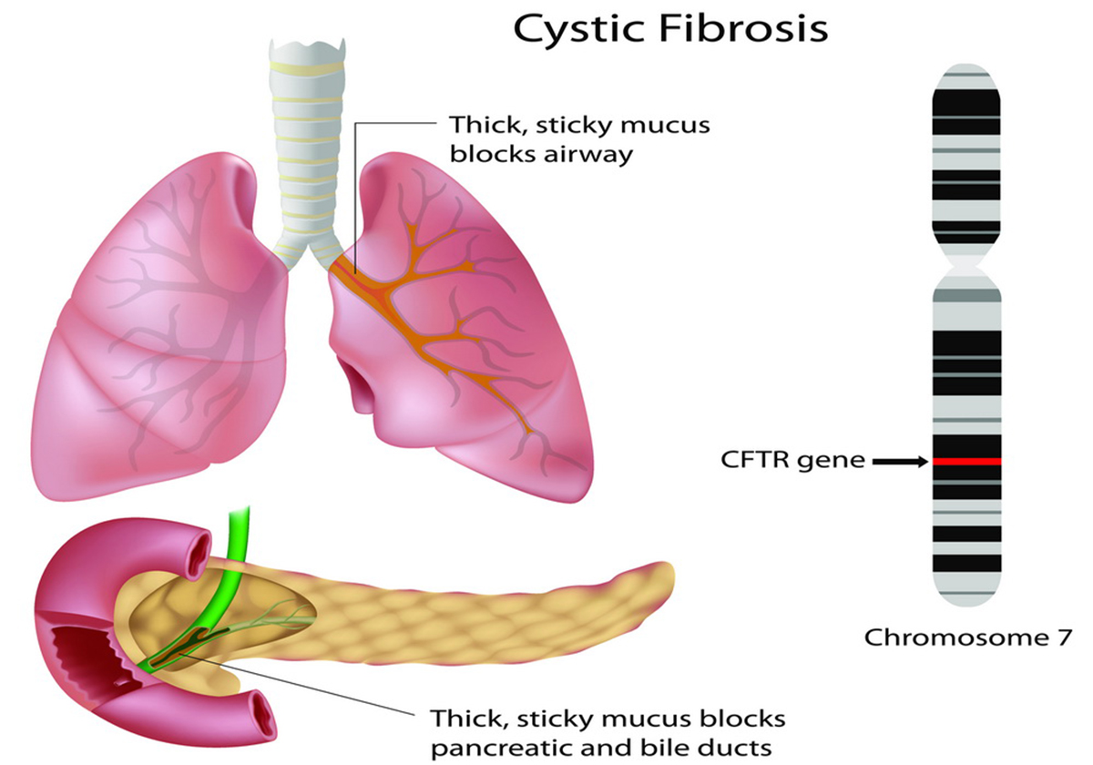 Living with Cystic Fibrosis Respiratory tract disorders and diseases