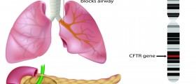 Living with Cystic Fibrosis