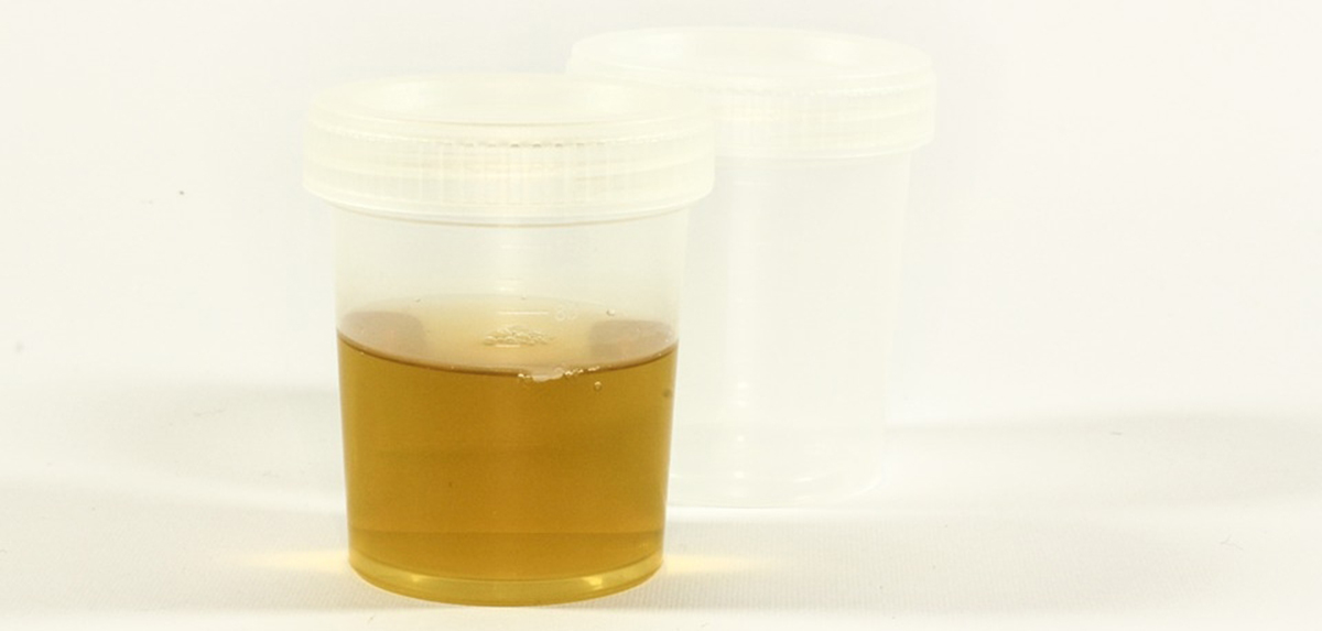 Dark Urine Sample 