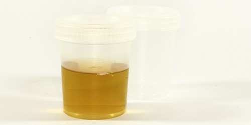 Dark Urine: What Could Be Wrong With You If Your Pee Is Brown Or Black?
