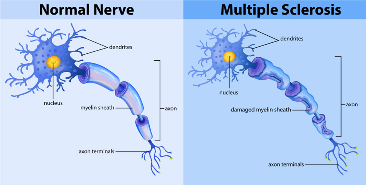 Defining Multiple Sclerosis What’s the Role of Myelin, Immunemediated