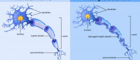 Defining Multiple Sclerosis: What’s the Role of Myelin, Immune-mediated Disease And T-Cells