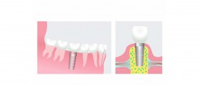 Dental Implants as a Solution to Missing Teeth