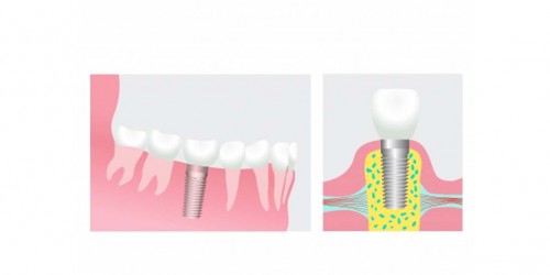Dental Implants as a Solution to Missing Teeth