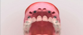 Risks Associated With Dental Implant Surgery