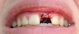 What To Expect From Dental Implant Surgery