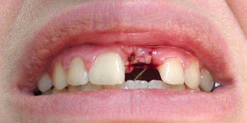 What To Expect From Dental Implant Surgery