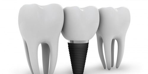 How Successful Are Dental Implants And When Are They More Likely to Fail?