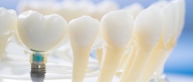 Хотите зубные имплантаты? Вот то, что вы должны знать, прежде чем серьезно рассмотреть их