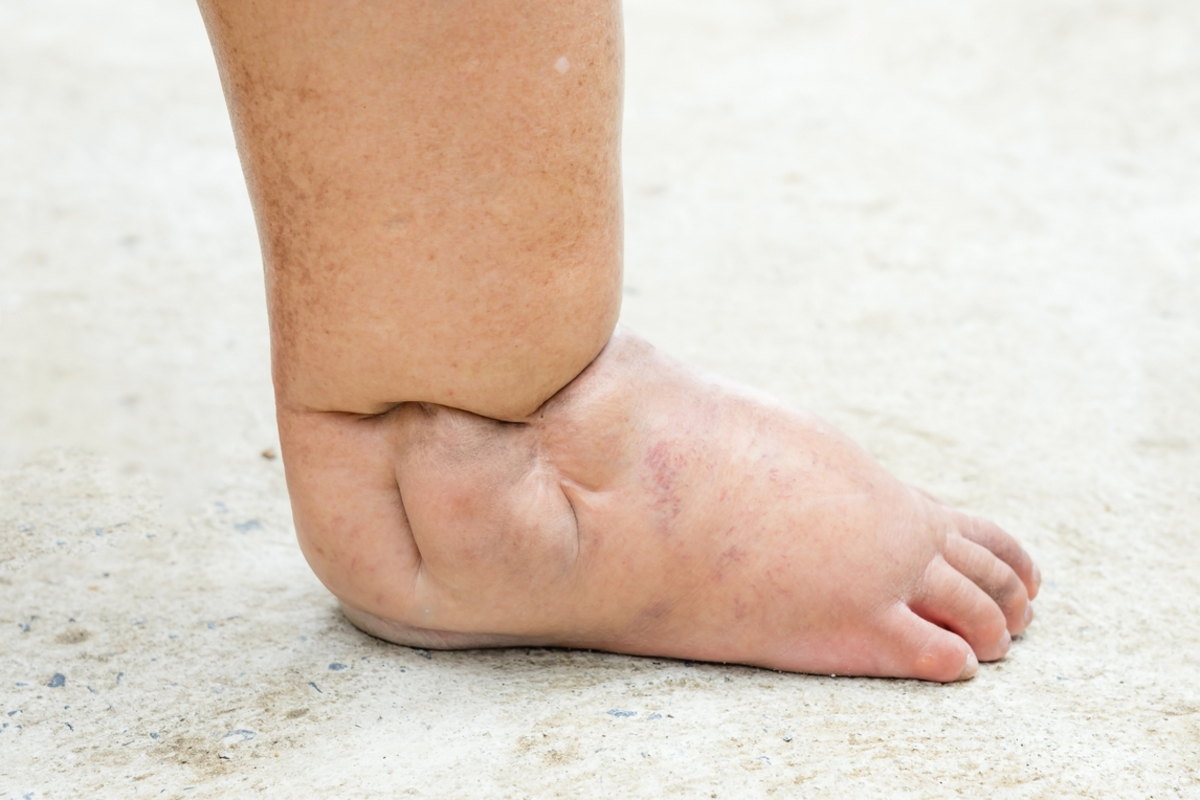 糖尿病患者的脚 糖尿病足 脚部皮肤角化增生和裂缝 特写 库存图片 - 图片 包括有 爱好健美者, 医学: 172731899