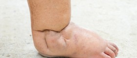 Diabetes And Amputation: How Can You Prevent Diabetic Foot Problems?