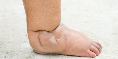 Diabetes And Amputation: How Can You Prevent Diabetic Foot Problems?