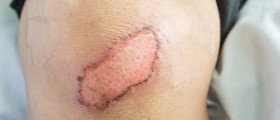 Diabetes And Slow Healing Of Cuts And Wounds: How To Speed Up The Healing Process?