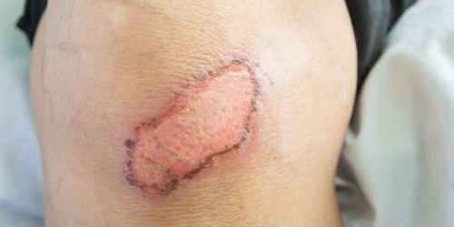 Diabetes And Slow Healing Of Cuts And Wounds: How To Speed Up The Healing Process?