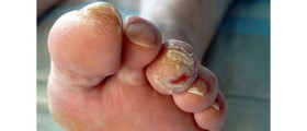 Why Does Diabetes Cause So Many Problems With Feet?