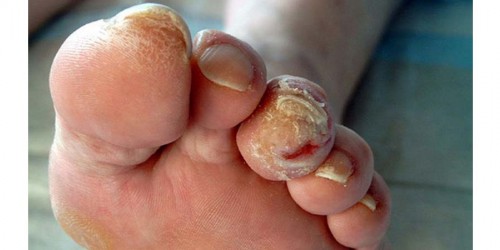 Why Does Diabetes Cause So Many Problems With Feet?