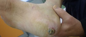 New Treatment Heals Diabetic Skin Wounds Fast