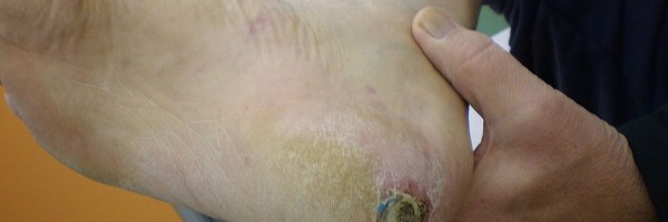 New Treatment Heals Diabetic Skin Wounds Fast