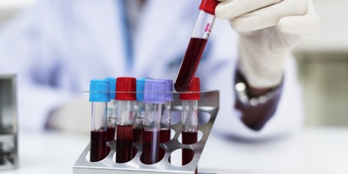 Diagnosing Hypothyroidism (Underactive Thyroid): Interpreting Thyroid Blood Tests And TSH Levels