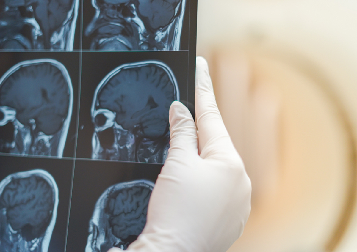 Diagnosing Multiple Sclerosis With Magnetic Resonance Imaging (MRI