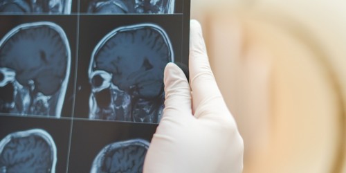 Diagnosing Multiple Sclerosis With Magnetic Resonance Imaging (MRI)