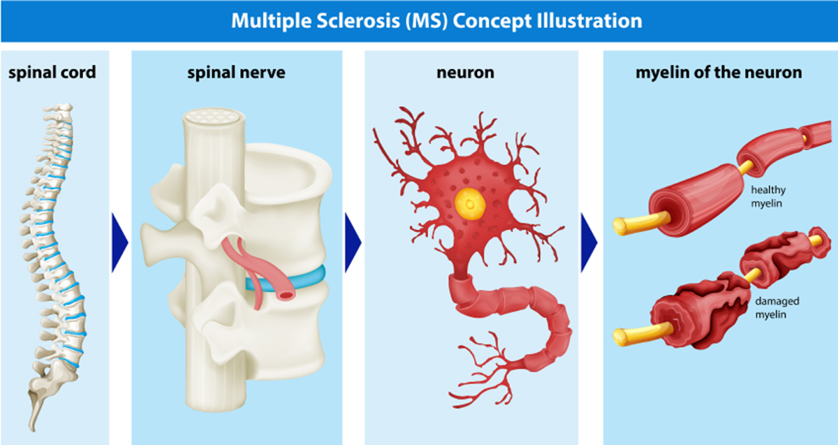 Diagnosing Multiple Sclerosis With Spinal Tap (Cerebrospinal Fluid