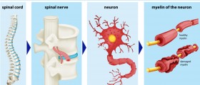 Diagnosing Multiple Sclerosis With Spinal Tap (Cerebrospinal Fluid)