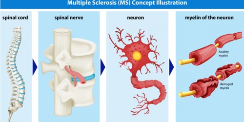 Diagnosing Multiple Sclerosis With Spinal Tap (Cerebrospinal Fluid)
