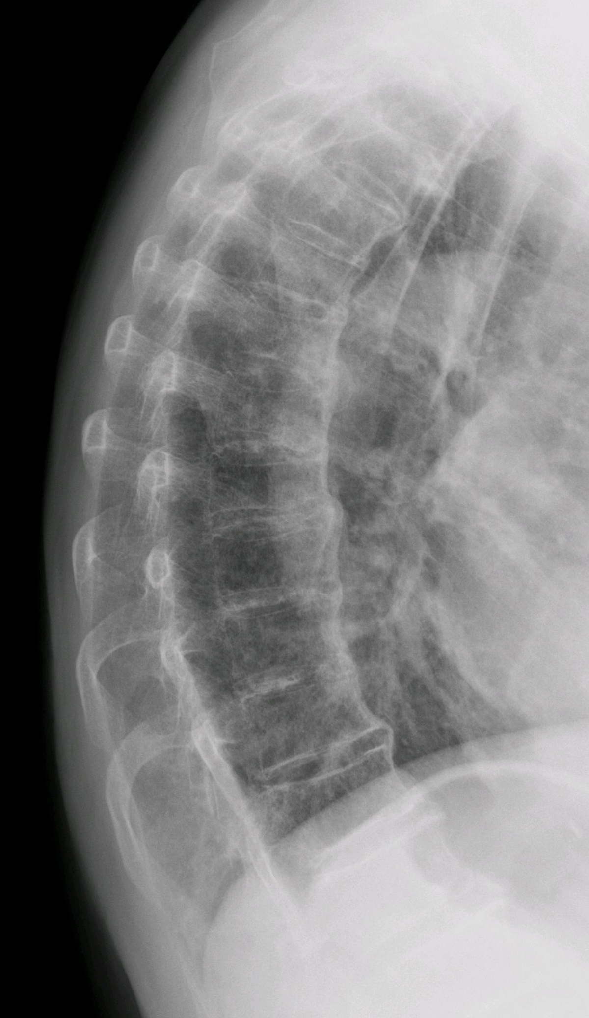 Diagnosed with DISH (Diffuse idiopathic skeletal hyperostosis