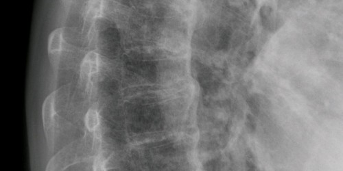 Diagnosed with DISH (Diffuse idiopathic skeletal hyperostosis)