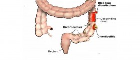 Diverticulitis: Causes, Risk Factors and Treatment