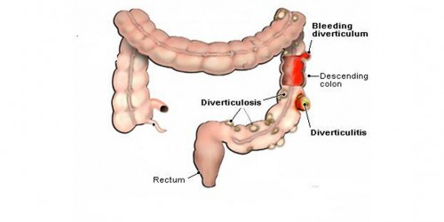 Diverticulitis: Causes, Risk Factors and Treatment
