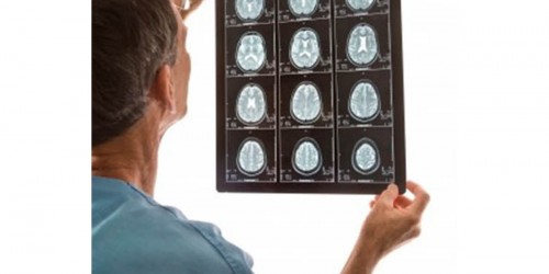 Traumatic Brain Injury Symptoms