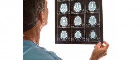 Can MRI Scans Lead to Unnecessary Breast Surgery?