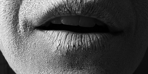 What Causes Dry Skin in Winter and How to Treat It?