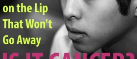 Dry Patch on the Lip That Won't Go Away: Is It Lip Cancer?