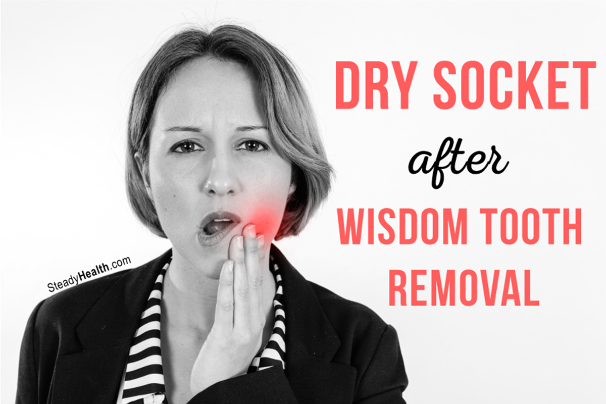 dry-socket-after-wisdom-tooth-removal-ear-nose-throat-and-dental